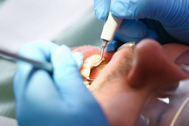 Best Emergency Dentist for Lost Fillings or Crowns in USA